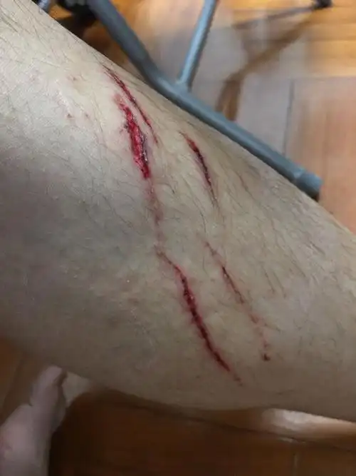 被钉鞋割伤了,已经消毒和包扎过了,回来打开绷带时发现伤口这个样子