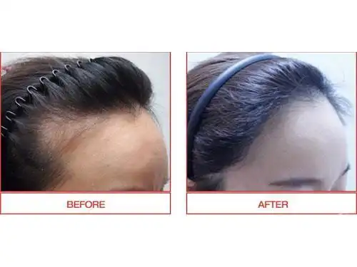 发际线种植前后对比