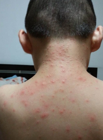 身体螨虫过敏症状图片 (15)_有来医生