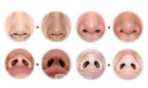 鼻孔缩小手术对比图鼻孔缩小这两种方法较有