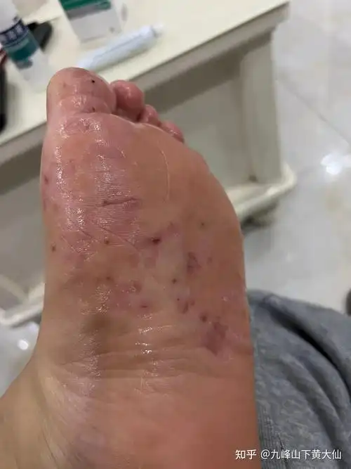 更新脚气治疗全过程~(配图)