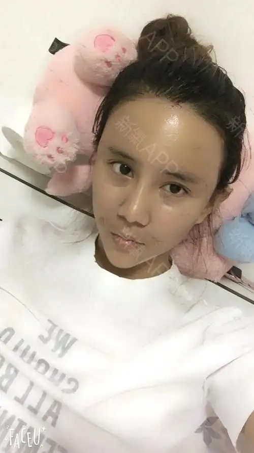 新氧- 谁谁谁45 | 自体脂肪填充全脸 | 术后当自强 | 上海同城 | 宁波