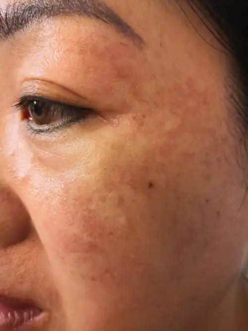 解决皮肤问题专注皮肤美容##使用化妆品过敏的这么多是为什么?