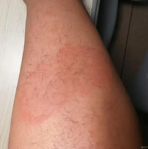 夏天皮肤总起这种红斑痒略带辣的疼