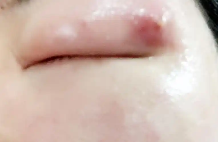 上眼睑靠近太阳穴的位置起了个火疖子连带这整个眼睛一起肿胀一