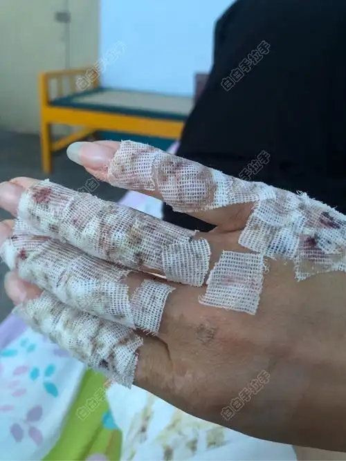 69 白癜风健康专区 69 手术移植 69 今天第11天,右手拆内纱布了