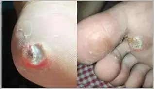 它们都是因为鞋子长期压迫摩擦脚部而形成:具体要怎么才能去掉鸡眼呢