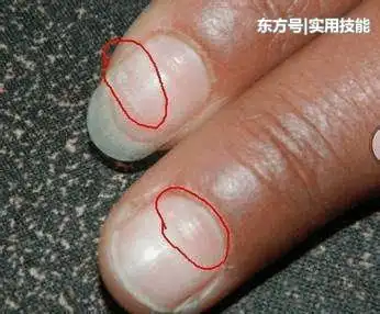 手指甲出现这4种状况, 当心是癌症的信号, 大意不得