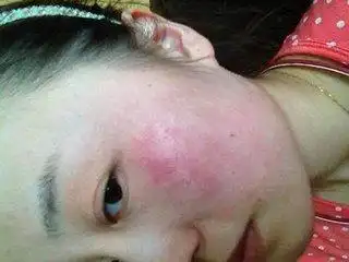 敏感肌肤有红血丝怎么护肤