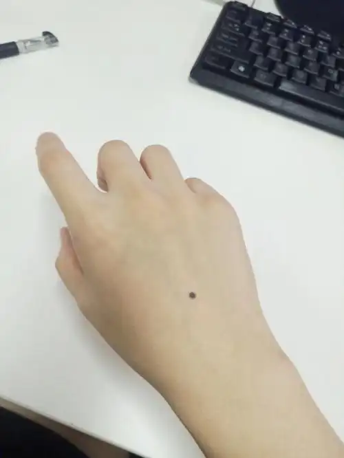 手上总是有一些奇奇怪怪的痣