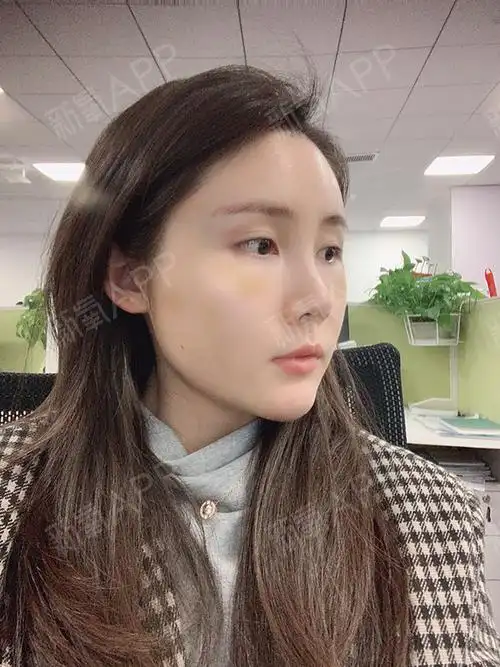 自体脂肪全面部填充恢复的第10天哈哈哈,自我感觉恢_圈子-新氧美容