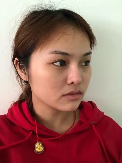 我的颧骨外凸,很难看,额头扁平,整个脸部就很平,没_圈子-新氧美容整形