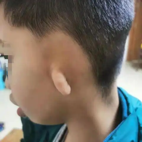 qing听丨深山里的无耳孩子有了新耳朵