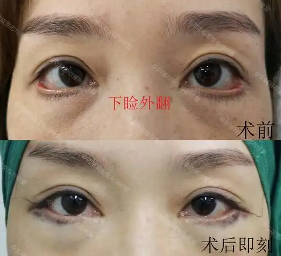 下睑外翻修复术后即刻