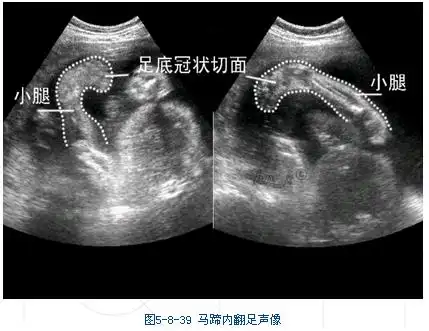 超声诊断696例胎儿脐带绕颈临床分析