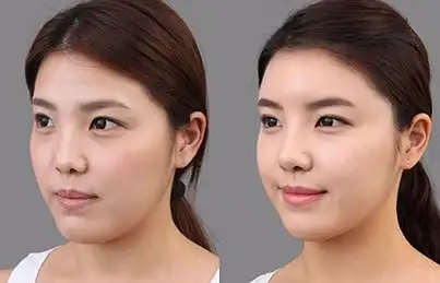 自体脂肪填充这几个部位你也可以变成少女脸