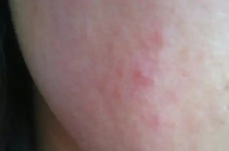 面部过敏引发疹病症是春季一种常见情况,可能由于接触过敏原或其他