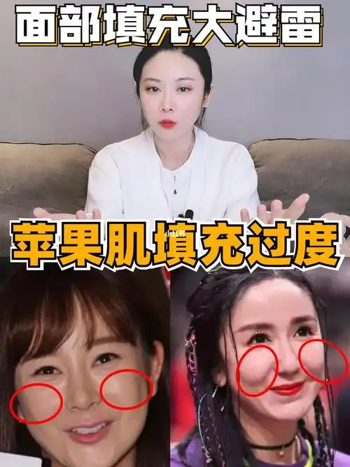 苹果肌在我们整个面部是有最高点的,如果填充太多,看上去就没有最高