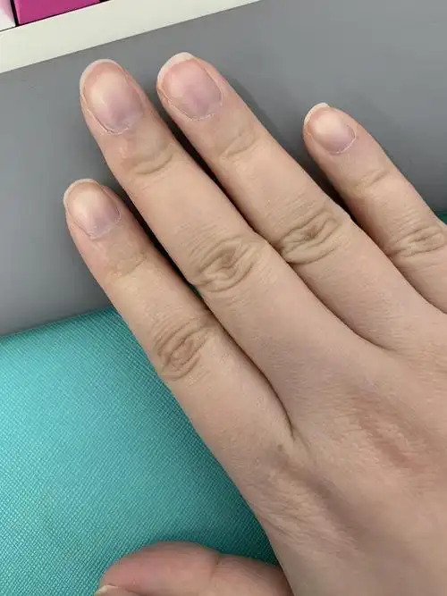 为什么手指甲发紫