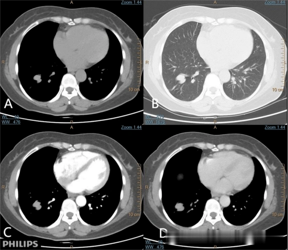 pet ct=真相!_病变_玻璃_显示