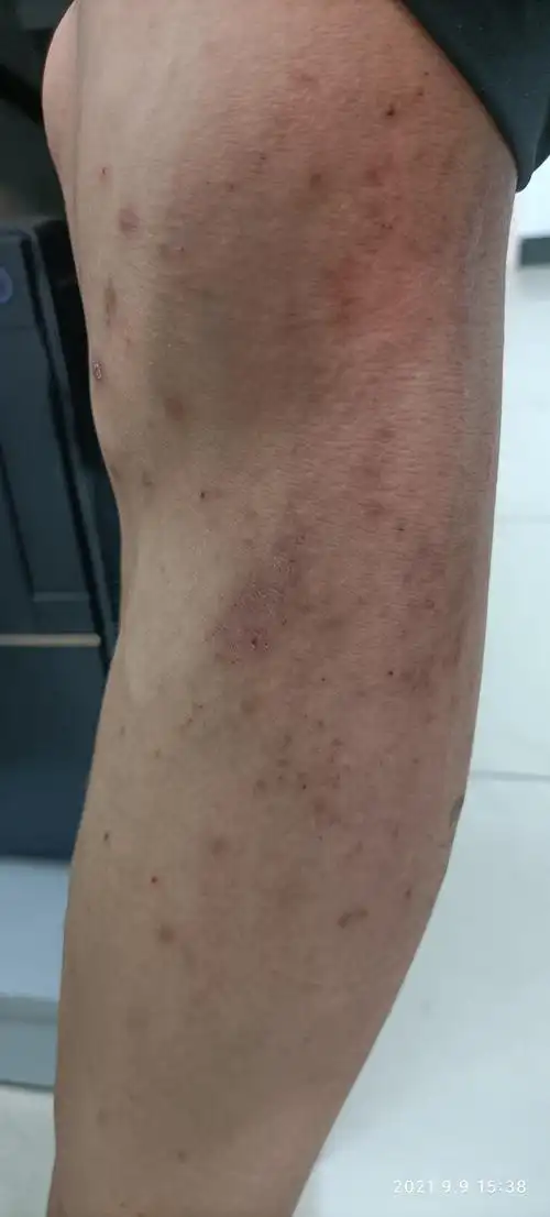 疥疮是一种由疥螨引起的一种烈性传染性皮肤病.