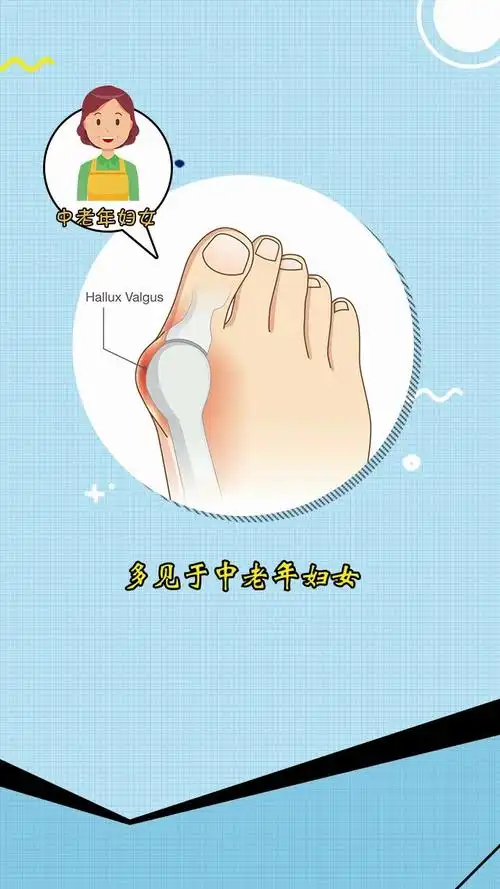 什么是大脚骨上海虹桥医院