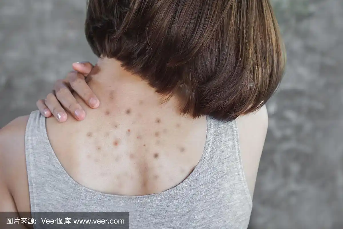 亚洲女性有痤疮,背部黑点和红点,皮肤问题概念