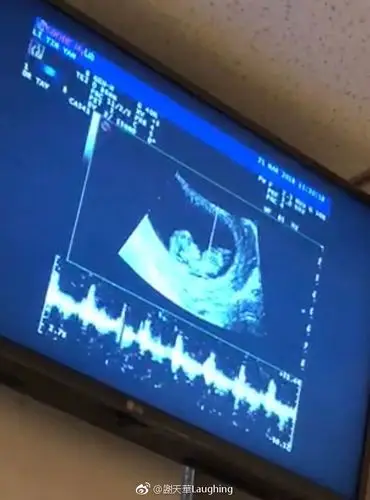 "   新浪娱乐讯 4月10日,谢天华微博晒出b超照,开心宣布老婆怀二胎