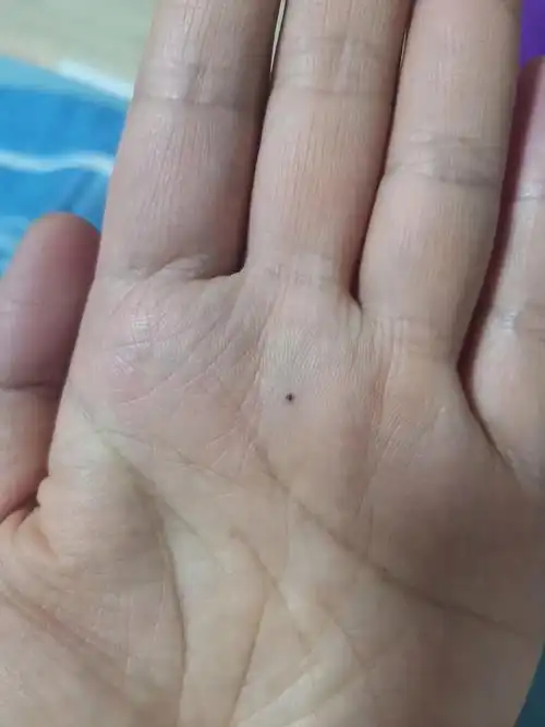 手掌长痣疼怎么回事(手掌长了一颗痣会致癌吗)