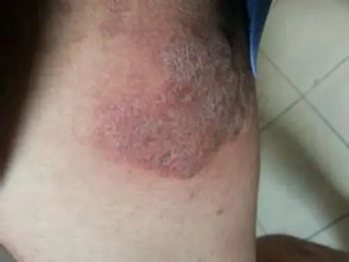 大腿外侧股癣 图片_有来医生