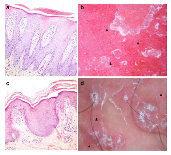 一文了解红色毛发糠疹与斑块型银屑病的皮肤镜鉴别