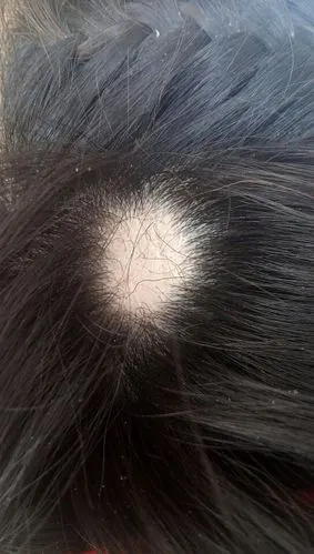 脱发的地方头皮有点发红,但是脱发的地方还