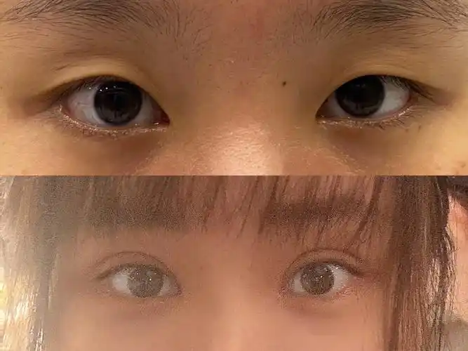 单眼皮变双眼皮的快乐78