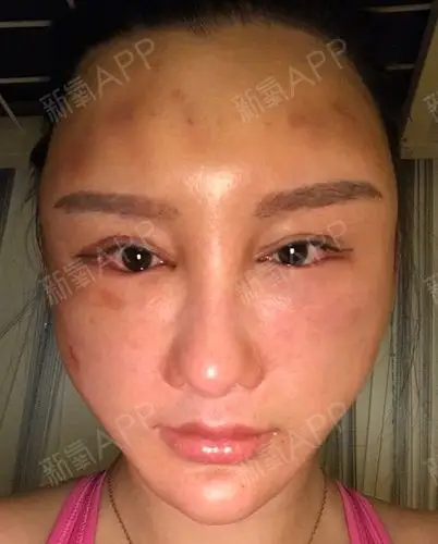 脂肪填充失败修复