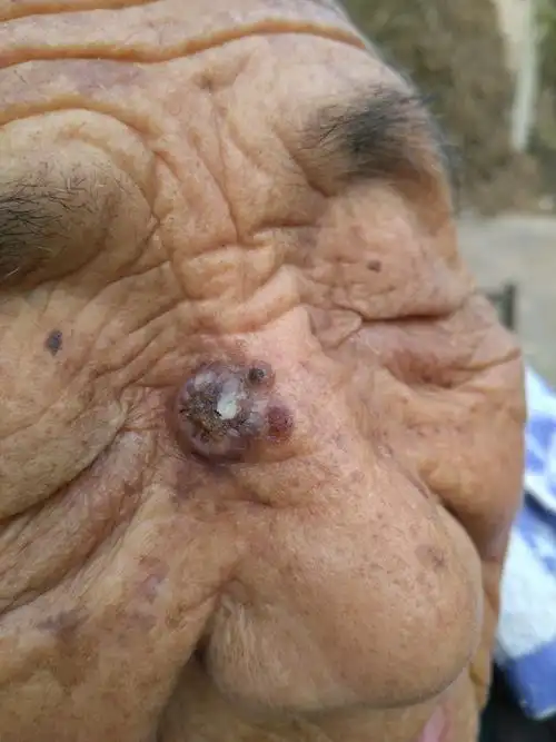 请教医生老年人这种皮肤病还是否需要手术