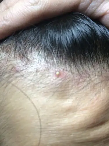 头皮毛囊炎 求大家帮帮忙 好痛苦 受其困扰好久了 大概有3年了 吃的药