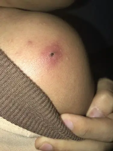 疖子长成这样了 摸点吃点什么药好的比较快