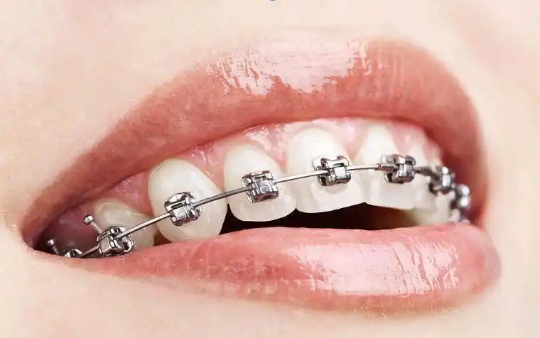 哪些症状需要矫正牙齿