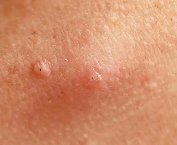 当毛囊炎到来时身体会出现4个表现留意到一个也要重视