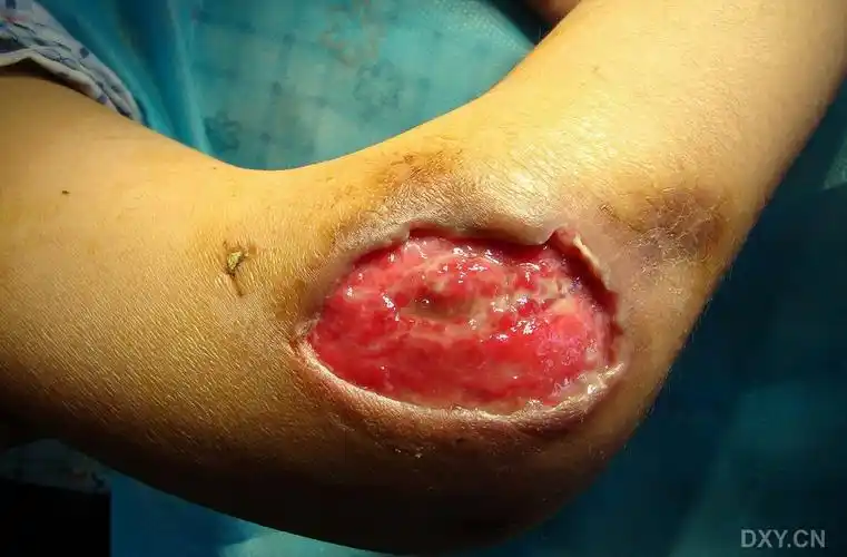 今日换药创面情况