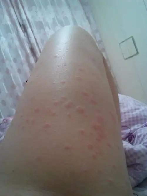 全身性荨麻疹(2个月了)中药西药都吃过 越来越严重 原来白天没有 现在