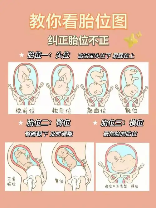 学会看胎位教你纠正胎位不正