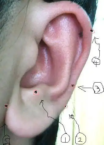 男人左耳朵长痣代表什么?能点掉么?上图看