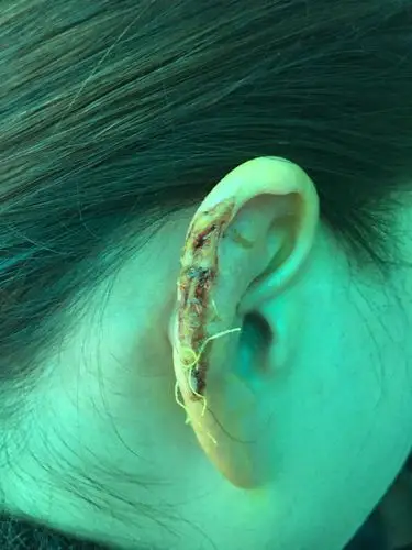 耳朵外轮廊被咬掉能长好吗