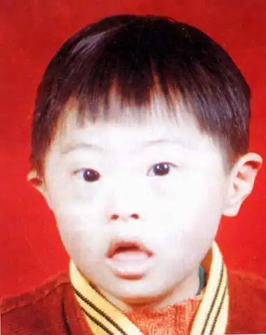 唐氏宝宝的眼睛,眼神是怎样的