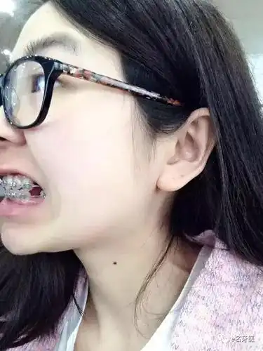 牙套一年半,厉害了我的乖宝宝,妹子的虎牙收敛了许多许多许多,当有人