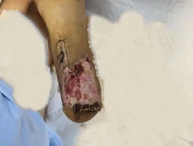 大姐突遭车祸截肢后伤口难愈医生治疗确实有些困难