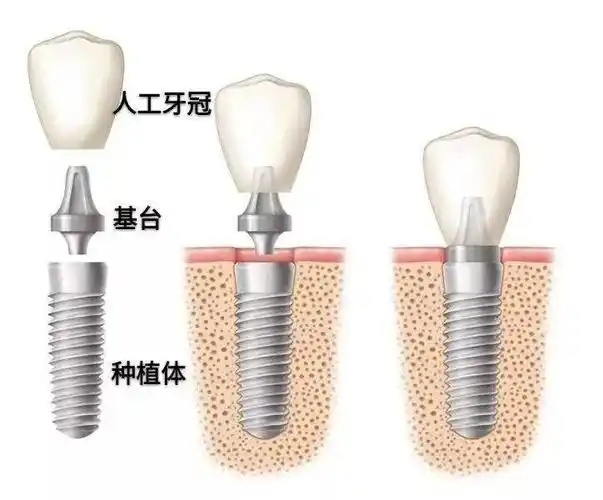 1,什么是种植牙?