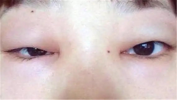 敷眼来消肿是利用高渗透压来迫使眼部的水分从眼部引流排走,去除水肿