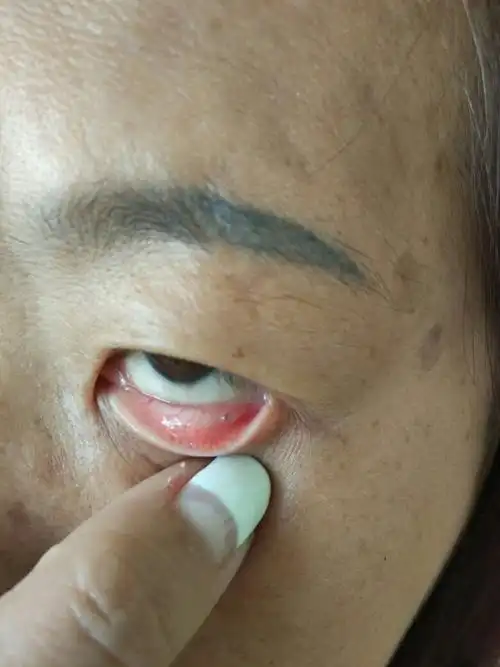 下眼睑里鼓起来一个透明的颗粒物.不疼不痒